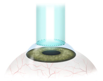 PKR laser de surface correction myopie astigmatisme
