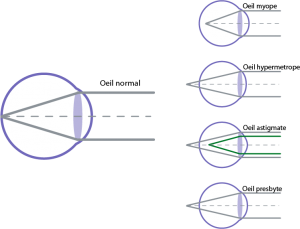 Illustration des défauts visuels opérés par laser 