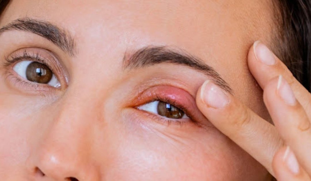 Le chalazion : causes, symptômes, traitements, préventions